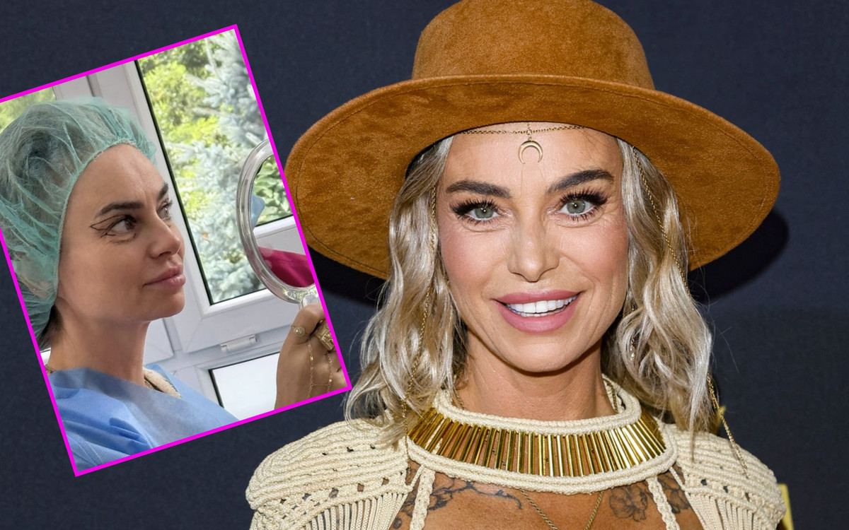 Kasia Nast w opatrunkach chwali się efektami operacji plastycznej! Zrelacjonowała fanom cały proces (FOTO)