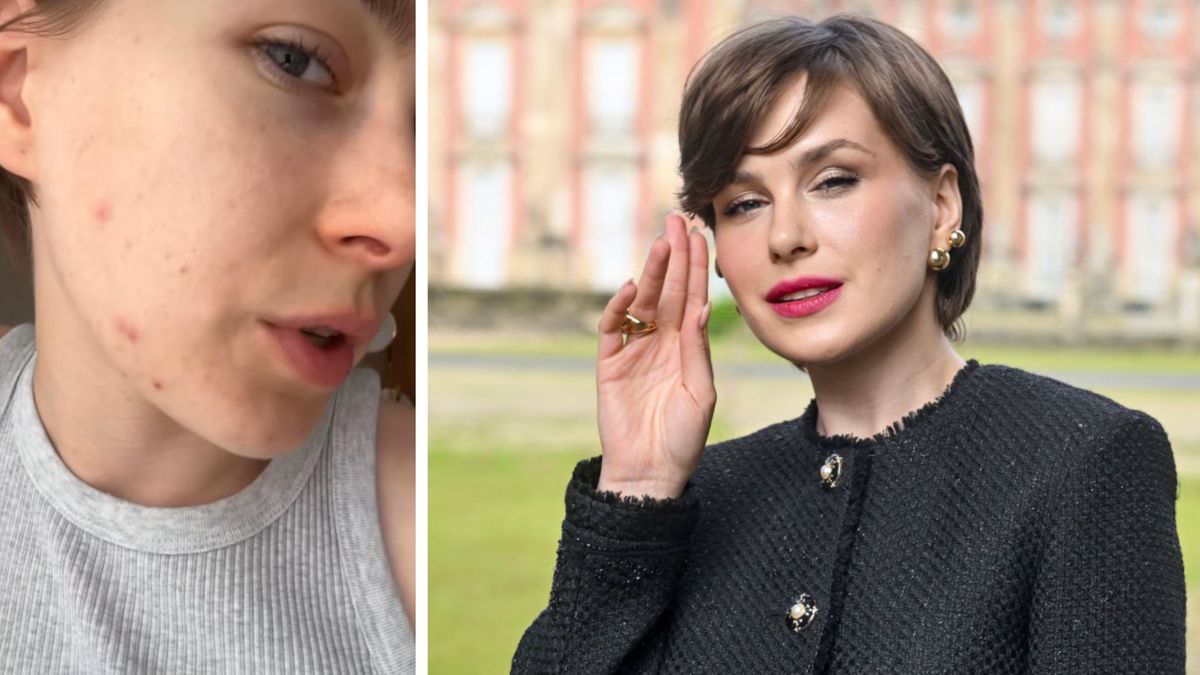 Anna-Maria Sieklucka o swoich problemach z cerą i jej akceptacji