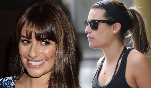 Te gwiazdy borykają się z trądzikiem