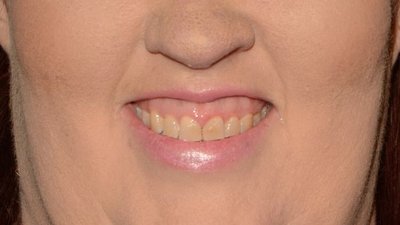 Mama June wydała 10 tysięcy dolarów na nowe zęby