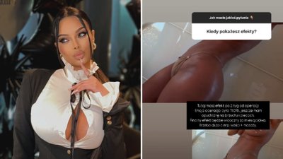 Justyna Gradek po kolejnej operacji plastycznej! Chwali się NOWYM CIAŁEM po liposukcji