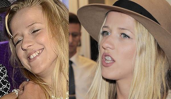 Jak zęby zmieniły twarze gwiazd