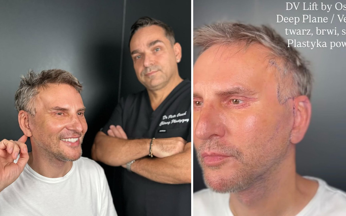Krzysztof Gojdź pokazał efekty głębokiego liftingu. Tak wygląda tydzień po operacji! ZDJĘCIA