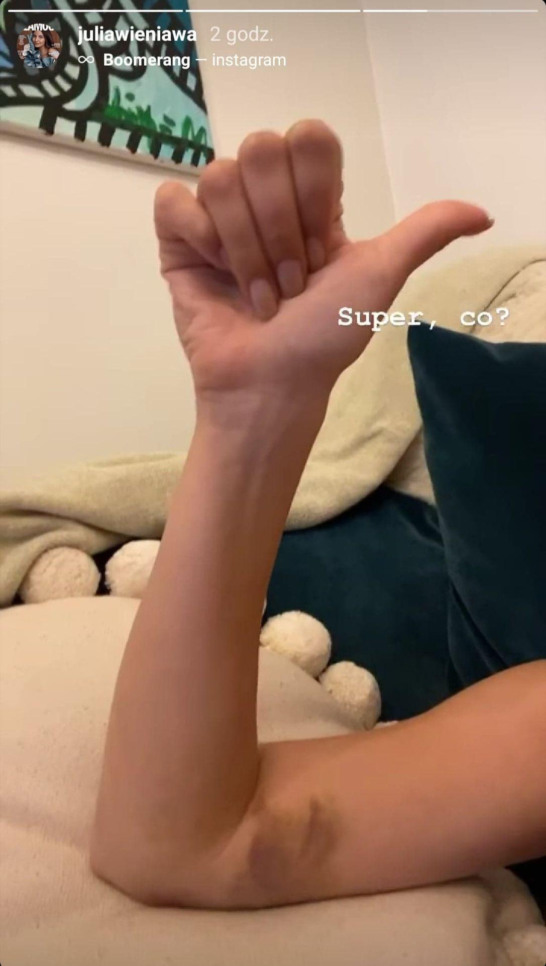 Julia Wieniawa z ogromnym siniakiem