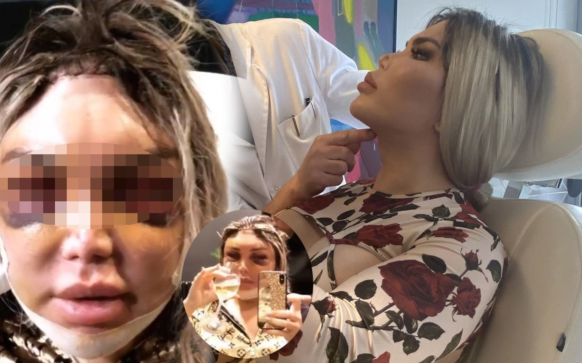 Roddy Alves w SINIAKACH po operacji twarzy, dzięki której ma wyglądać jak kobieta