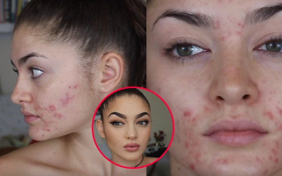 Szpeci ją trądzik, a potrafi zrobić się na MILION DOLARÓW