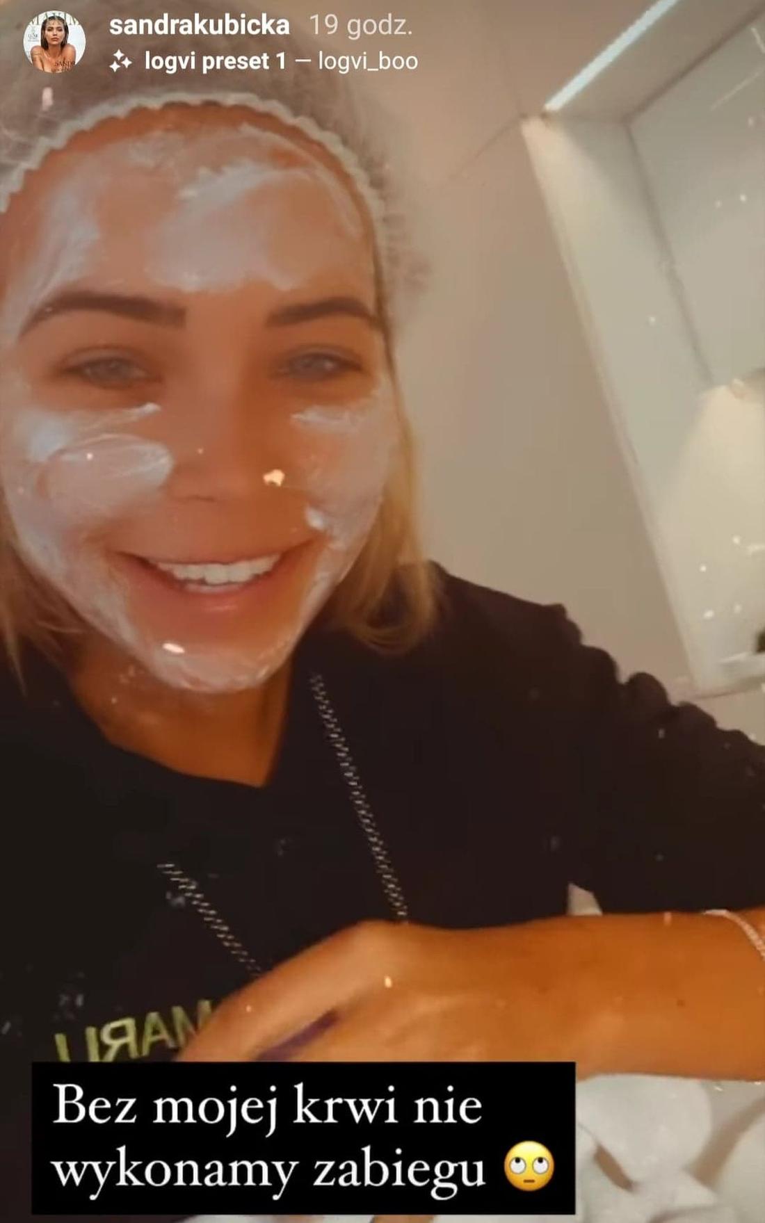 Sandra Kubicka na wampirzym liftingu