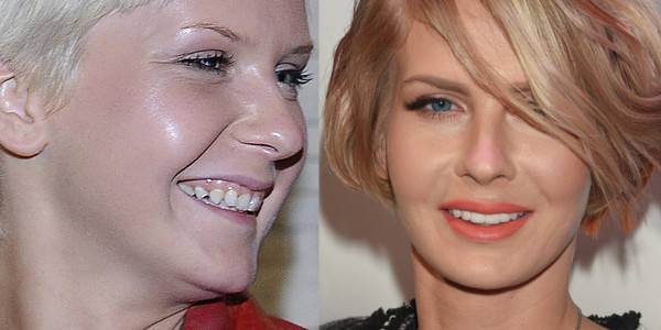 Jak zęby zmieniły twarze gwiazd