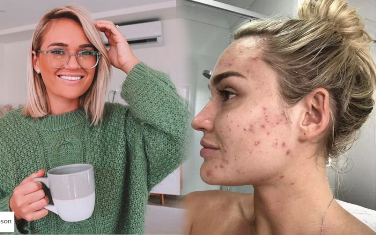 Australijska influencerka odkryła patent na trądzik. Niesamowite! Wystarczy mała buteleczka…