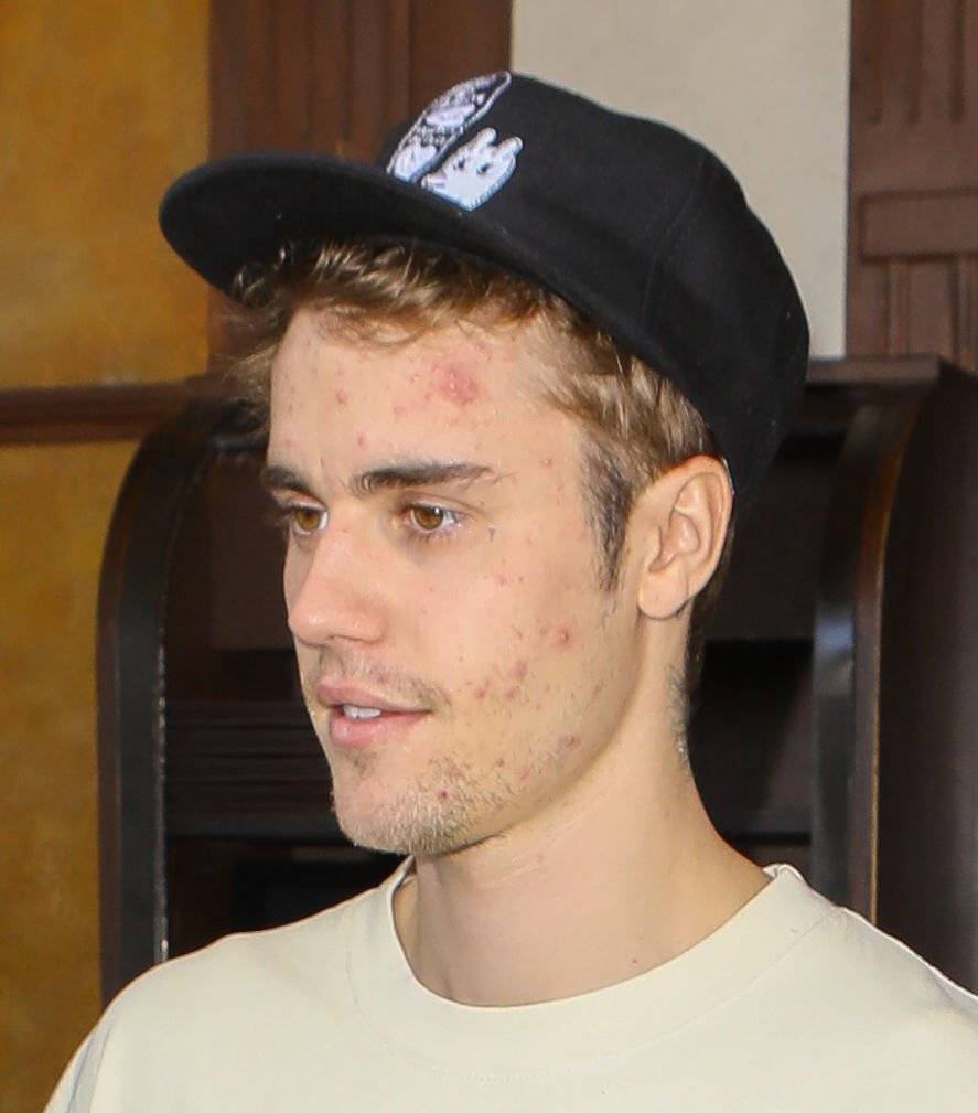 Justin ma poważne problemy z cerą – nie wygląda dobrze