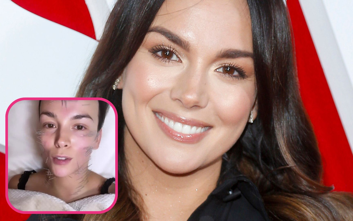 Paulina Krupińska zrobiła sobie BOLESNY zabieg na twarz