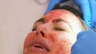 Kim Kardashian: Wampirzy lifting na wizji (FOTO)