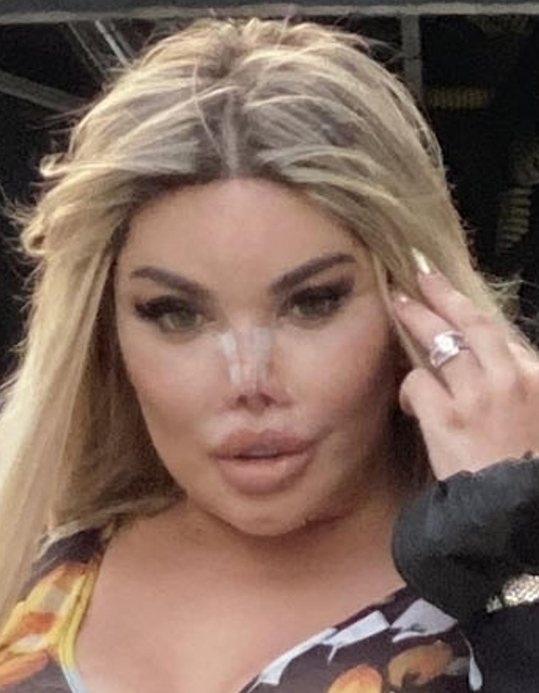 Jessica Alves po operacji plastycznej. 