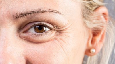 Zmarszczki mimiczne wokół oczu – jak skutecznie pozbyć się kurzych łapek?