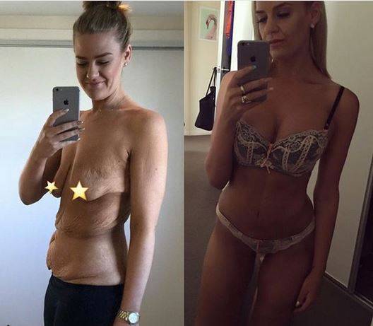 Schudła ponad 90 KILOGRAMÓW i nie uwierzycie, co stało się z jej CIAŁEM