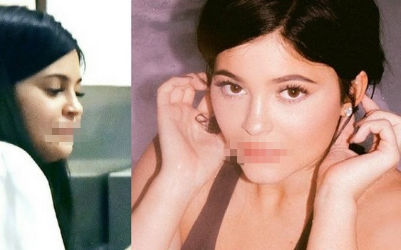 Co się dzieje z ustami Kylie?! Na temat jej wielkich warg wypowiedział się EKSPERT
