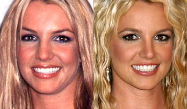 Jak operacja nosa zmieniała twarze gwiazd