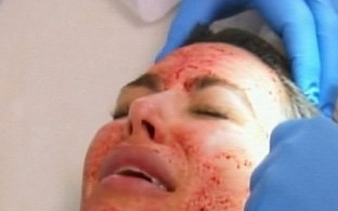 Kim Kardashian: Wampirzy lifting na wizji (FOTO)