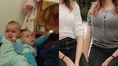 Rozdzielono je ponad 20 lat temu. Tak dziś wyglądają polskie bliźnięta syjamskie