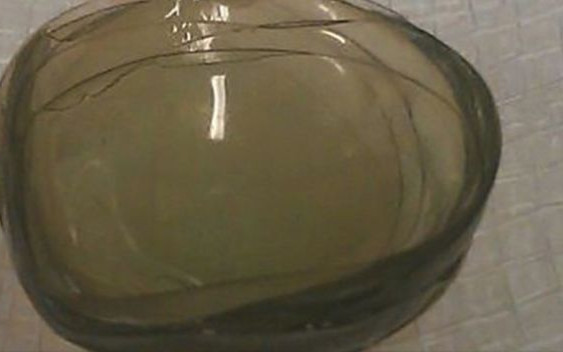 To wygląda obrzydliwie! Kobieta przez 20 lat nie wyciągała z oczu soczewek