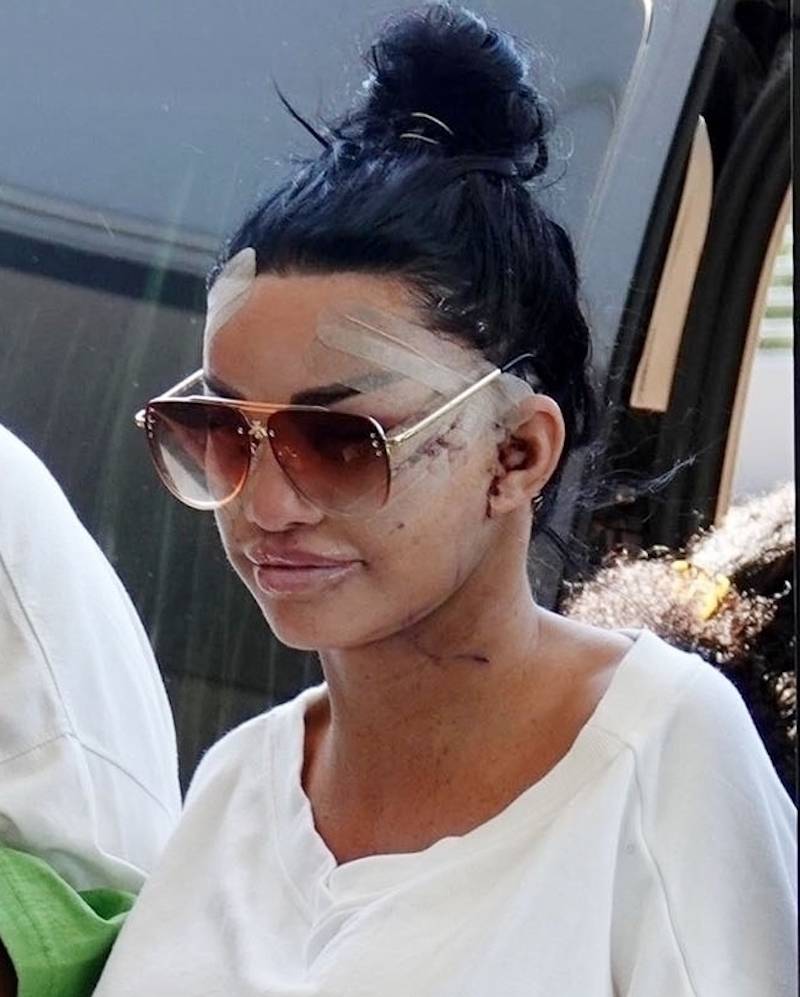 Katie Price po swoim 6 liftingu twarzy! Zauważona przed hotelem w Turcji