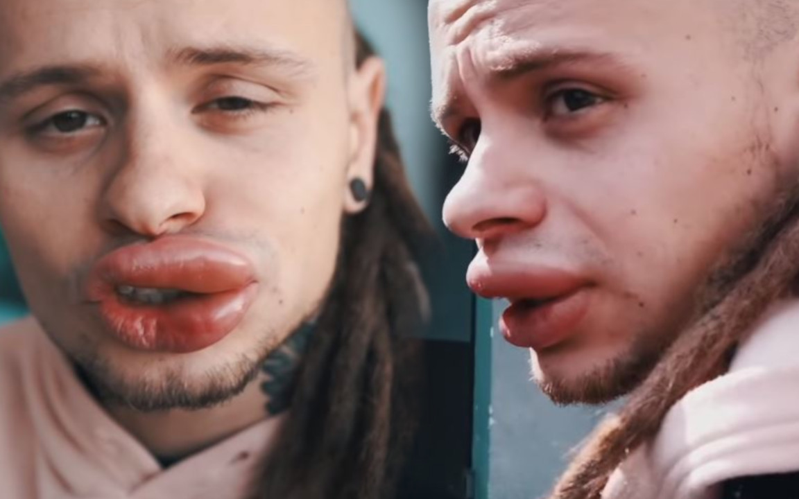 Mateusz z Fit Lovers trafił do SZPITALA! Opuchlizna na ustach może spowodować śmierć