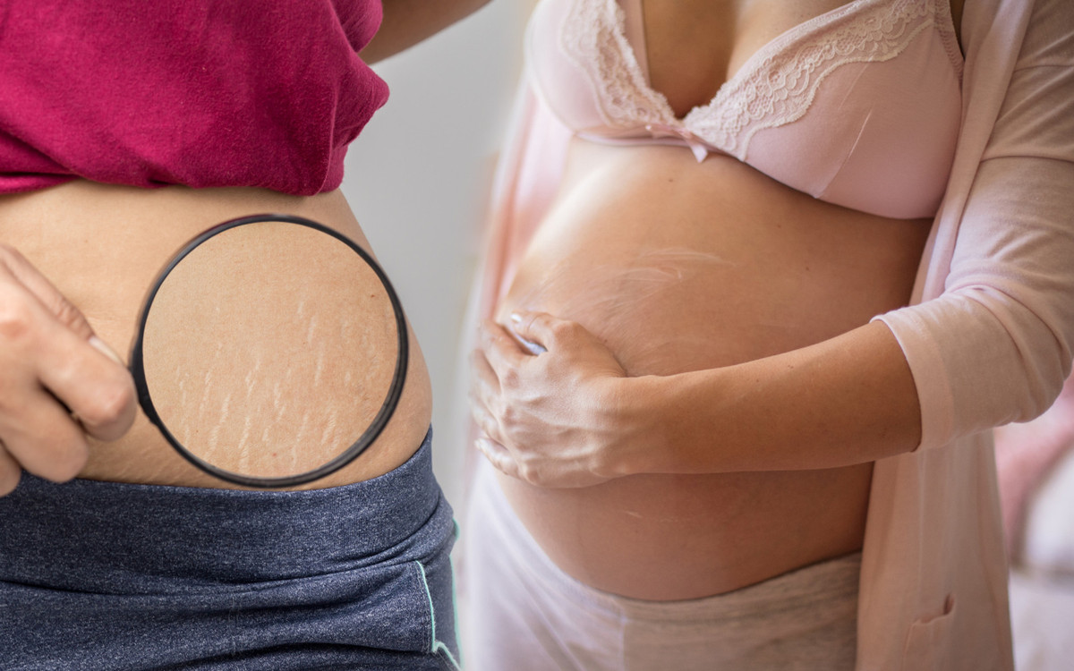 Dziwne? Zobacz, co te kobiety robią ze swoimi rozstępami