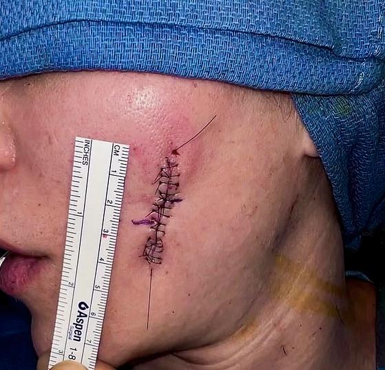 Khloe Kardashian czerniak