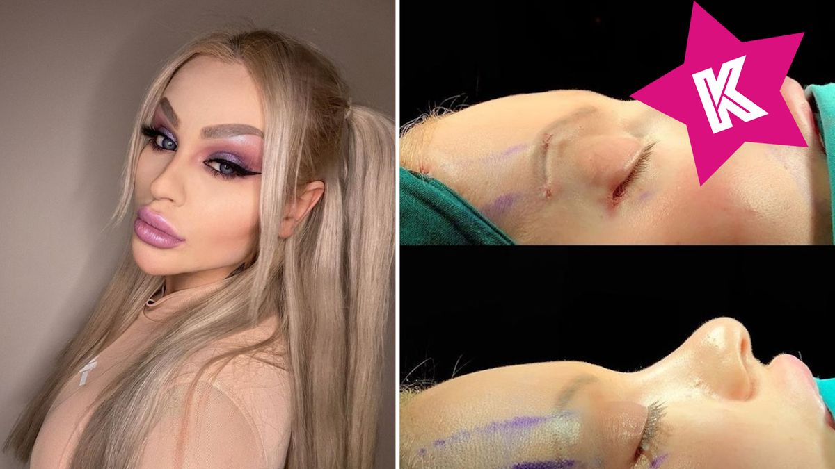 operacja nosa Ewelona