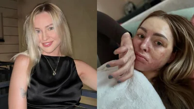 Poparzona Polka wciąż walczy w sądzie. Przykre, co ją spotkało