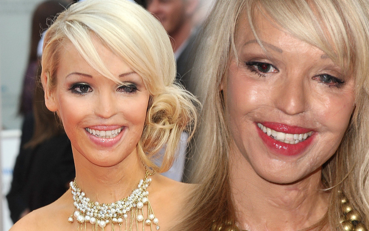 Poparzona kwasem Katie Piper w sesji zdjęciowej dla Harper’s Bazaar