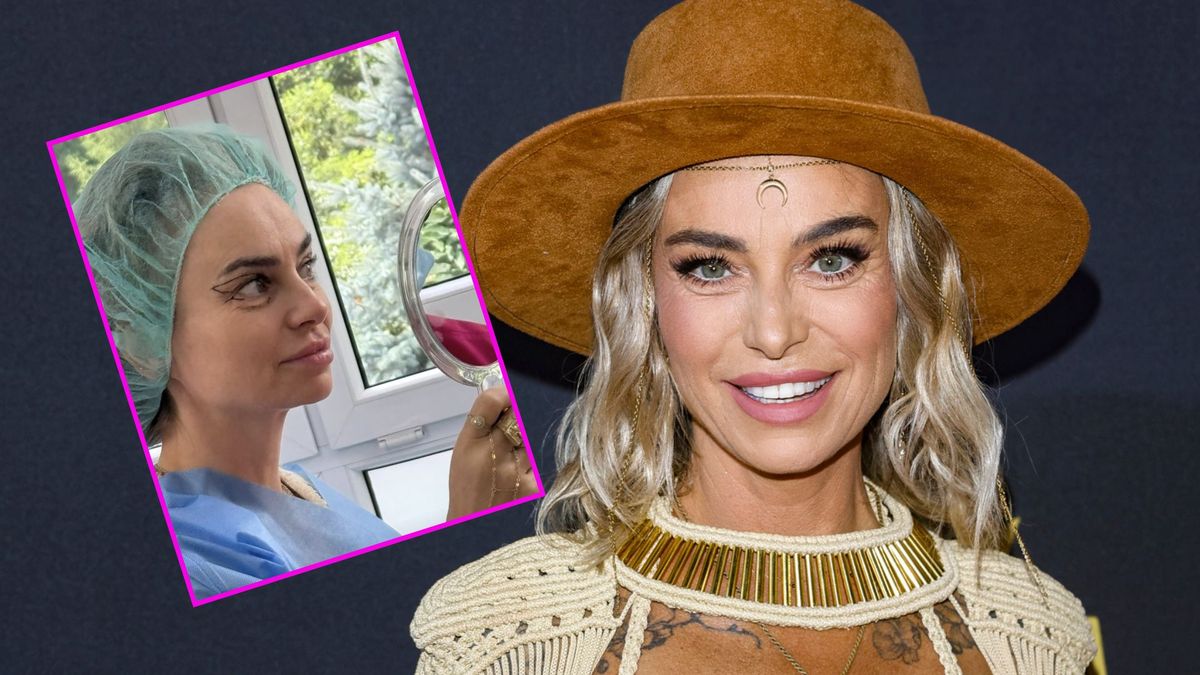 Kasia Nast w opatrunkach chwali się efektami operacji plastycznej! Zrelacjonowała fanom cały proces (FOTO)