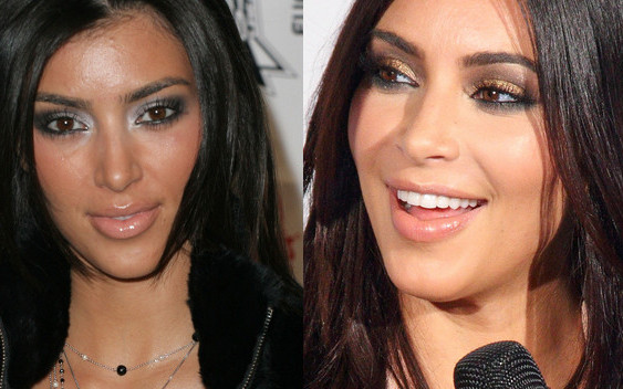 Jakich zabiegów urodowych żałują gwiazdy?