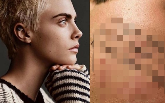 Cara pokazuje cały policzek w pryszczach!