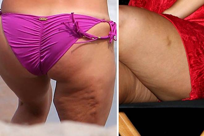 Gwiazdy, które walczą z cellulitem