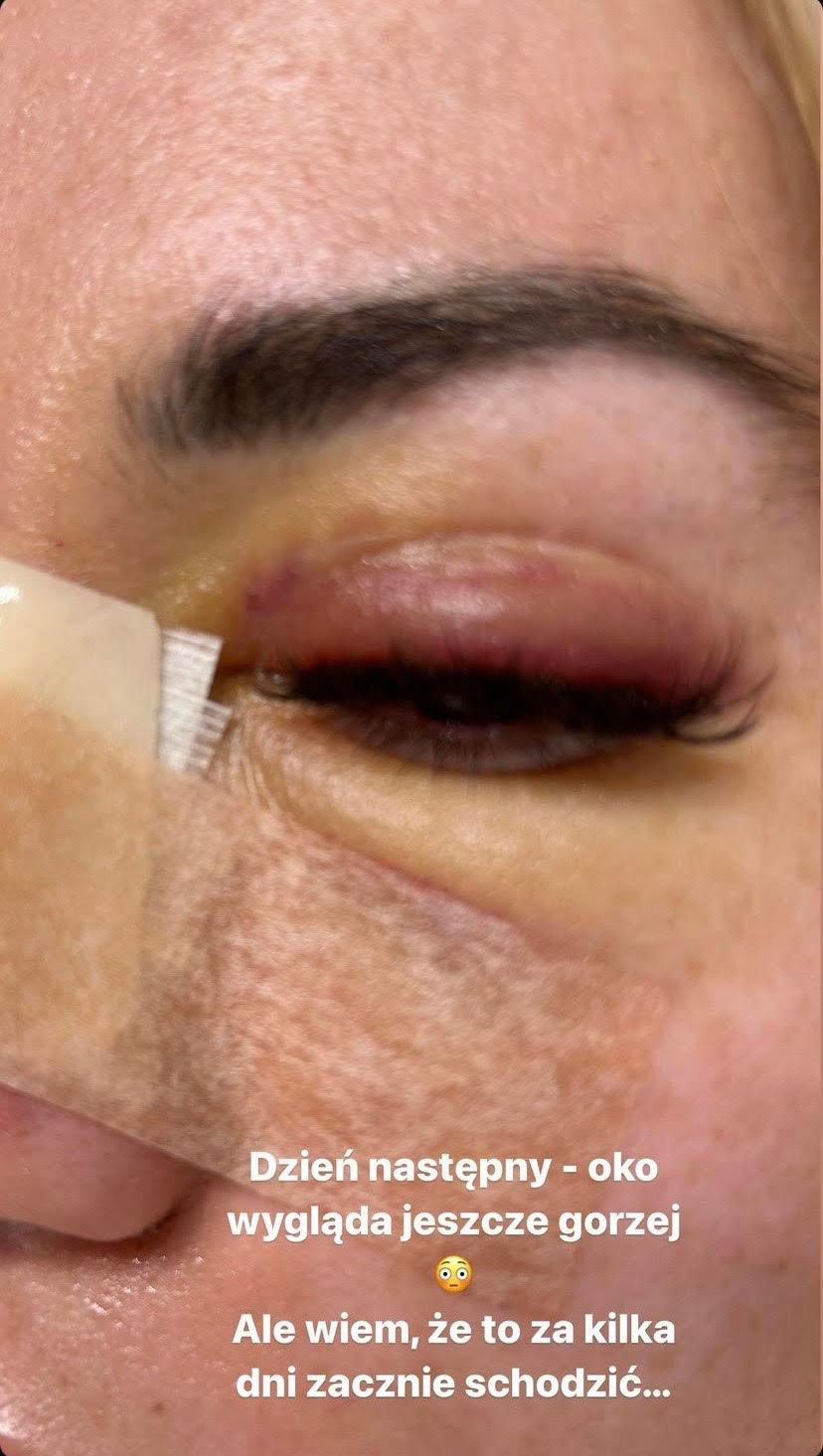 Marianna Schreiber po operacji nosa