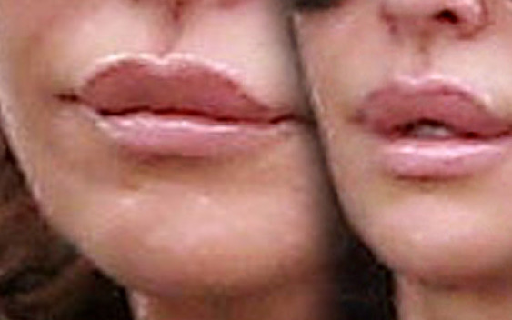 Nie wytrzymała długo bez spuchniętych ust (FOTO)