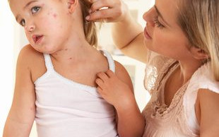 Koszmar. Zmarło dziecko zarażone chorobą podczas ospa-party