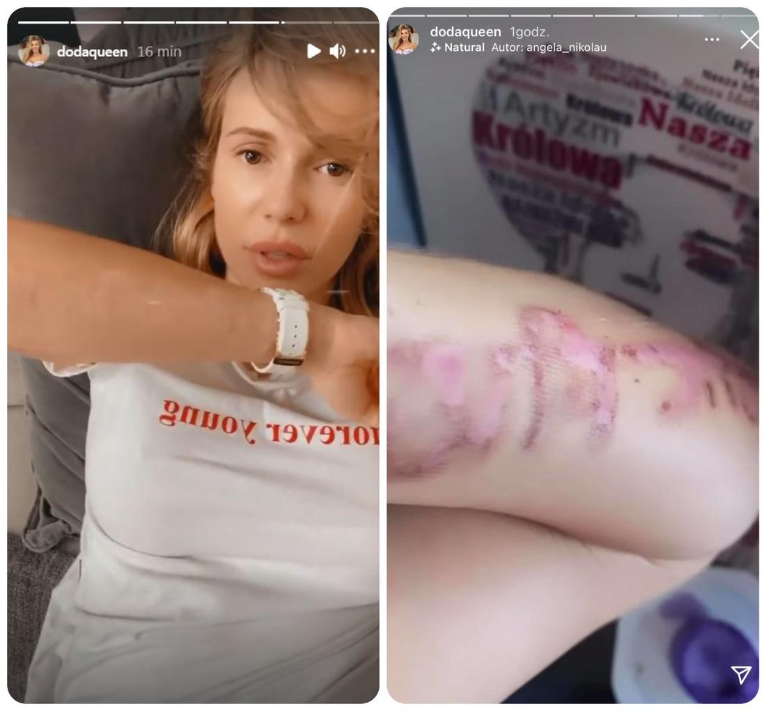 Doda pokazała, jak wygląda jej ręka po usuwanie tatuażu. 