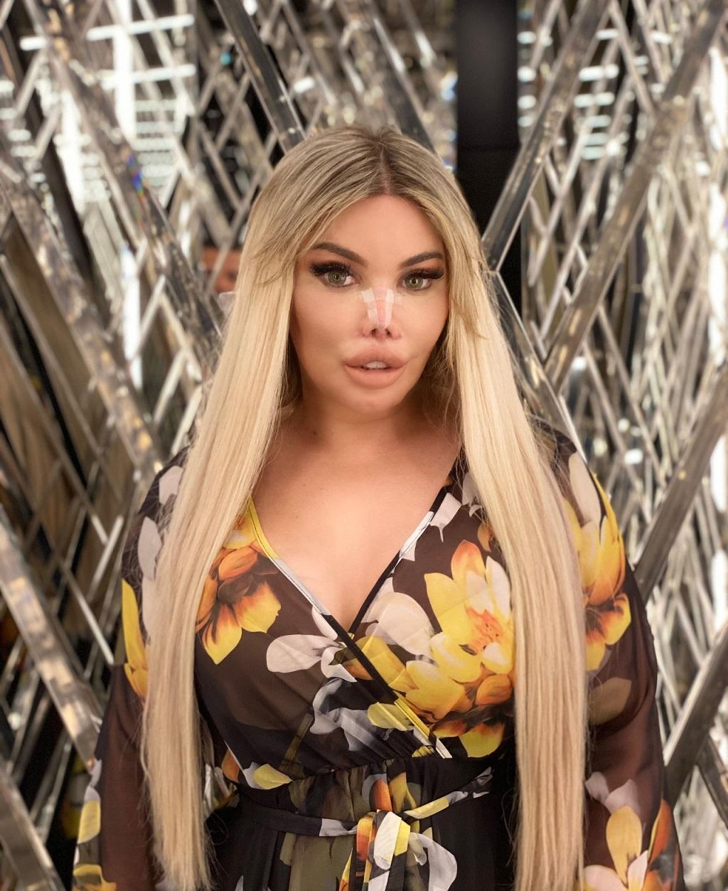 Jessica Alves ponownie zoperowała nos. 