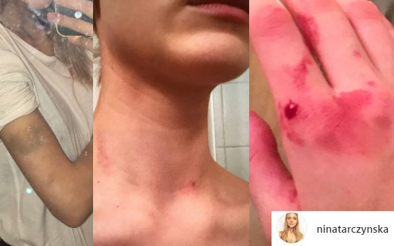 KOSZMAR! Polska modelka POBITA przez chłopaka (Instagram)