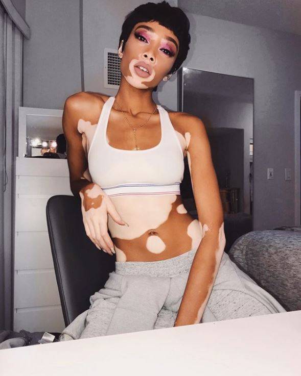 Winnie Harlow: Dzieci nazywały mnie krową