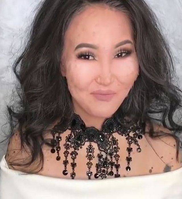 Ta dziewczyna miała całą twarz w ZNAMIONACH. Zobaczcie, CO jej pomogło!