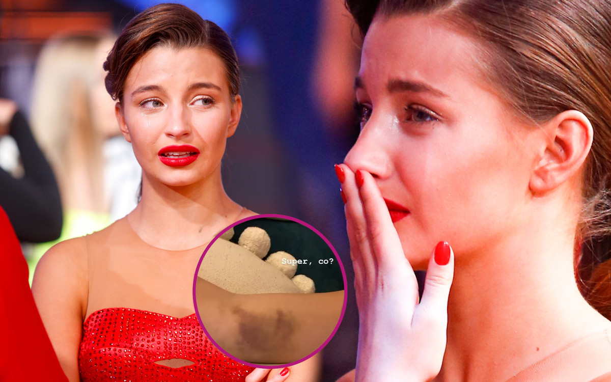 Julia Wieniawa z wielkim siniakiem. “Jestem załamana. Nie mogę ruszać ręką”