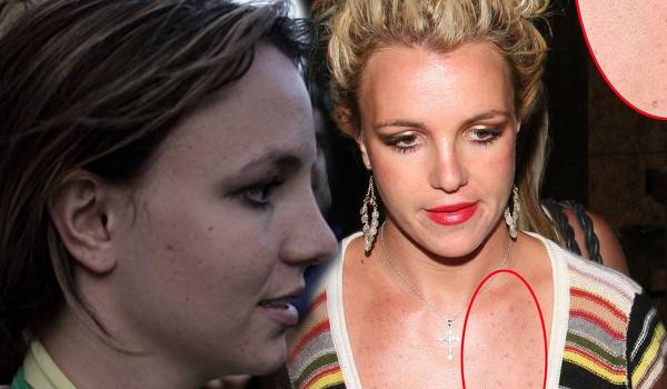 Te gwiazdy borykają się z trądzikiem