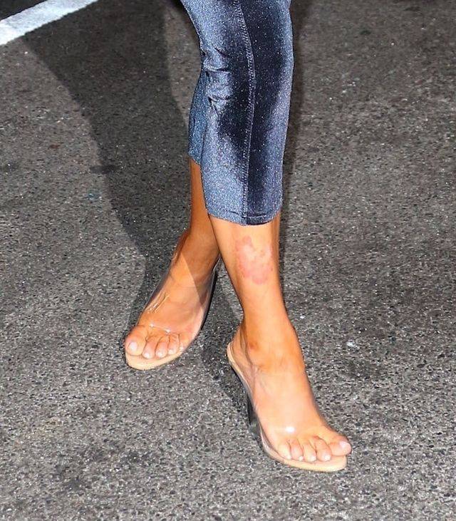 Łuszczyca znów dokucza Kim Kardashian