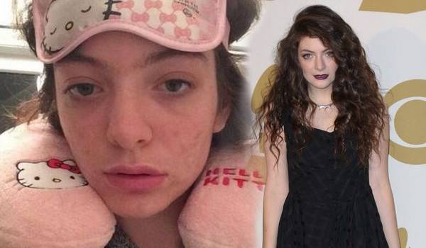 Te gwiazdy borykają się z trądzikiem