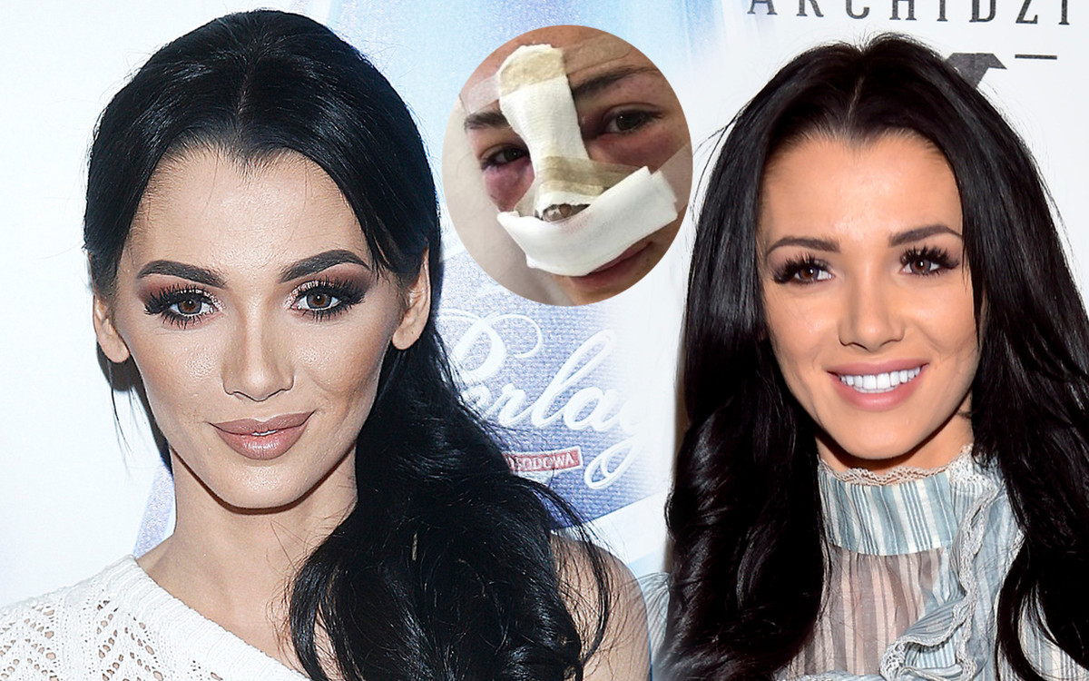 Lilly Marchel pokazała zdjęcia po drugiej operacji nosa