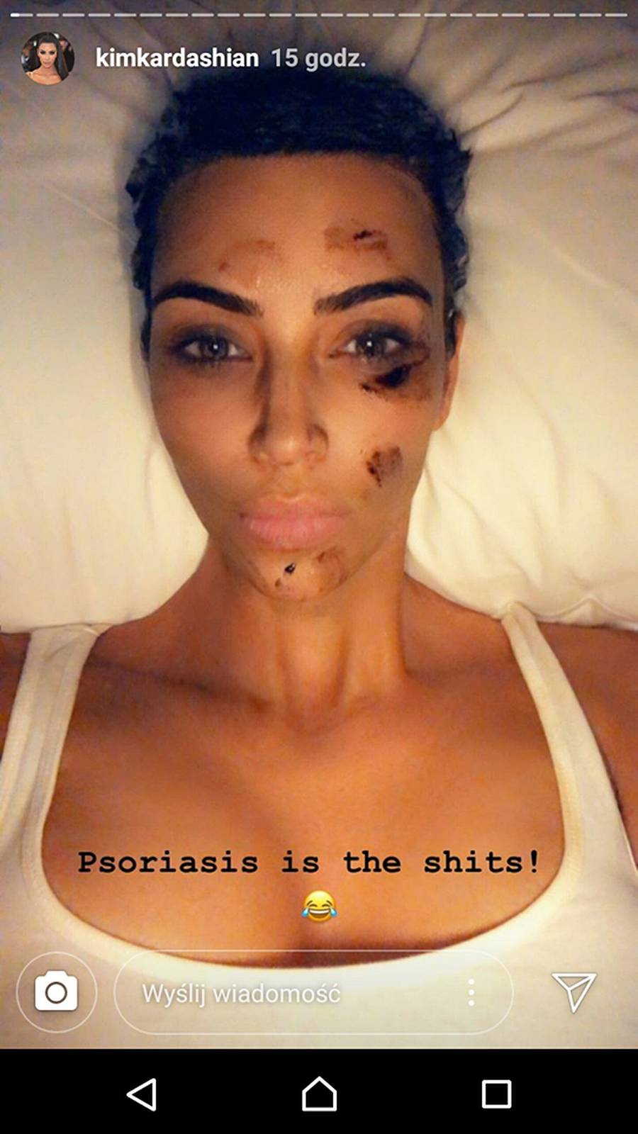 Kim Kardashian pokazała PRZERAŻAJĄCE zdjęcia z łuszczycą