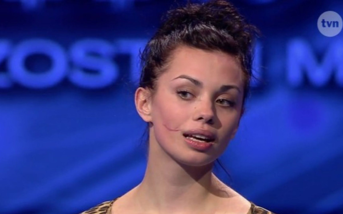 Uczestniczka “Top Model” z blizną. Anna Koryto przeszła gigantyczną metamorfozę